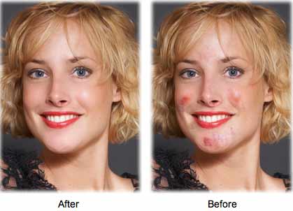 Remover espinhas e marcas das fotos - Editar fotografias esconder acne